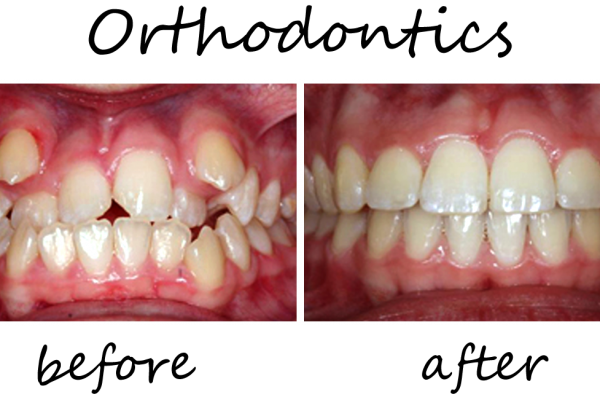 Orthodontics4